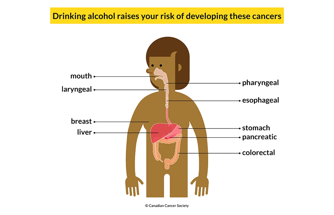 Drinking Less is Better - Some sobering facts about alcohol and cancer risk